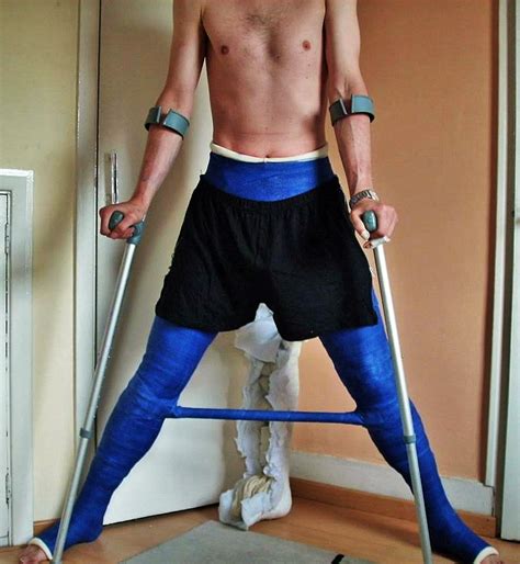 man blue double hip spica with spreader bar body cast full body cast