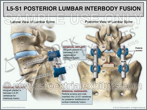 posterior lumbar interbody fusion plif spinal fusion surgery lumbar spine surgery