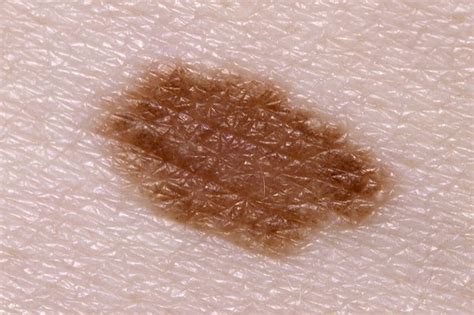 Skin Cancer Melanoma Symptoms Nhs Uk