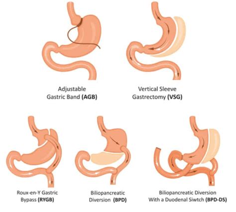 types  bariatric surgery