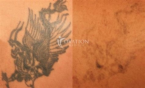 tattoo removal  houston ovation med spa