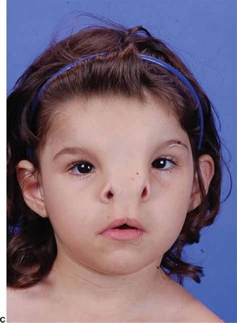 Craniofacial Clefts And Hypertelorbitism Grabb And Smith S Plastic