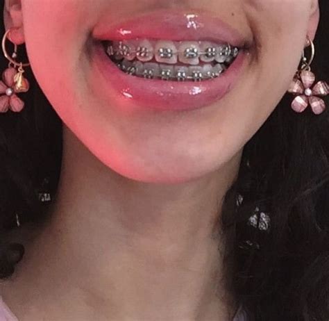 pin by surovtsevva on my aesthetic cute braces braces girls cute
