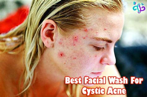 top 15 best facial wash for cystic acne 2021 reviews tacky living