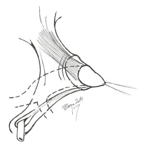 The Role Of Clitoral Anatomy In Female To Male Sex Reassignment Surgery