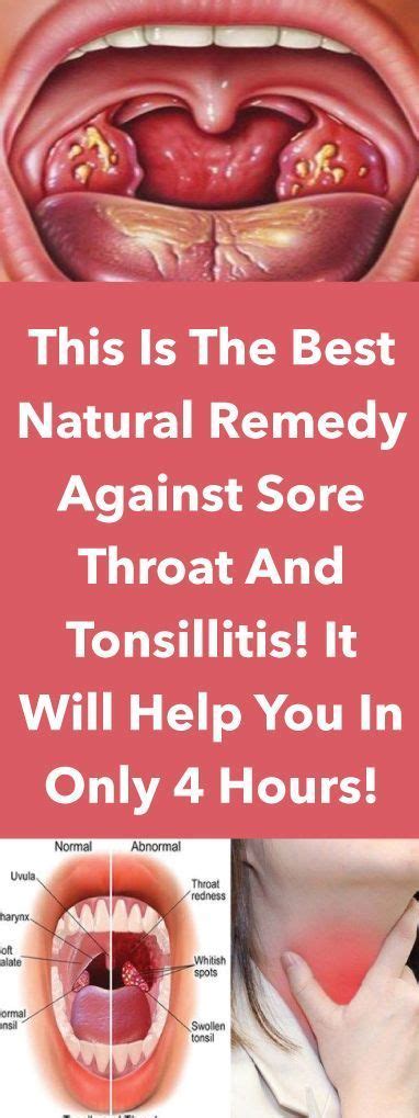 Treating Your Sore Throat Without Medication How Home Remedies Can