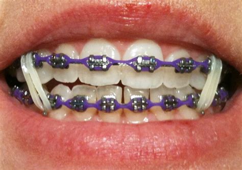 Rubber Bands On My Braces Men S Tips