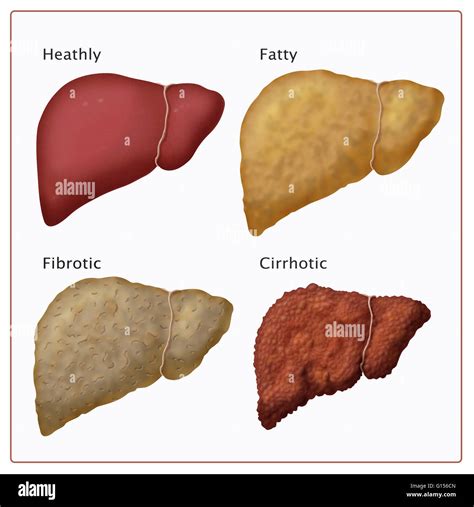 Stages Of Liver Damage Starting From A Healthy Liver Top Left Stock