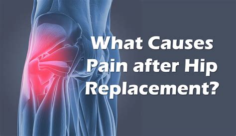 Pain After Hip Replacement Is It Your Tendons Regenexx