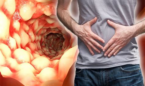 crohn s disease symptoms and treatments are you at risk
