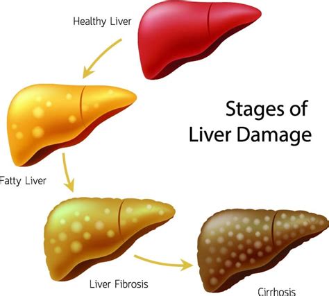 Recognizing The Early Symptoms Of Liver Disease – Alcoholic And Non