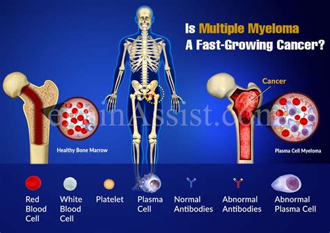 multiple myeloma  fast growing cancer