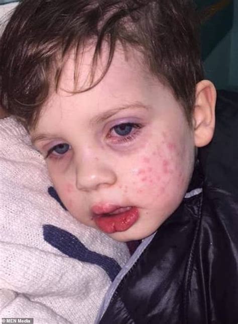 mother s warning after her three year old catches the herpes virus after being kissed by a