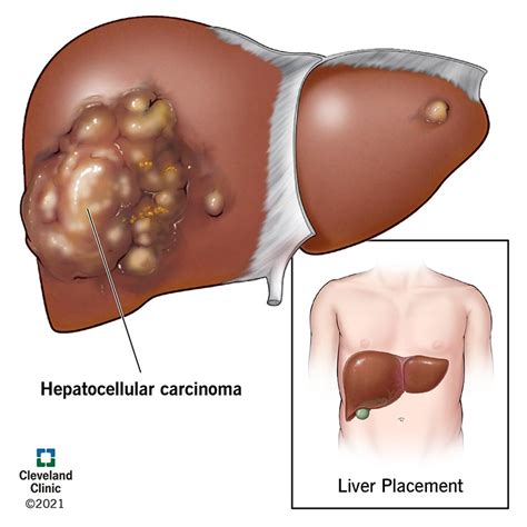 understanding liver tumors   nurse expert