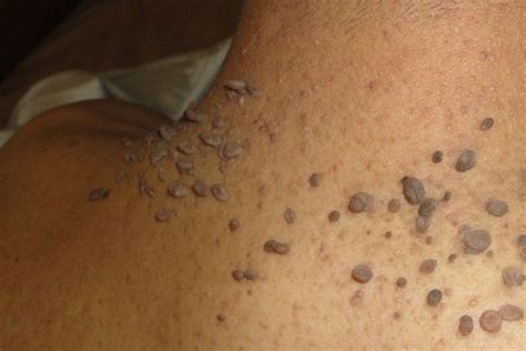 bumpy moles skin tag removal skin tag treat skin