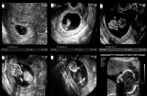 transvaginal scan baby magazine