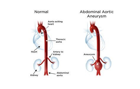 aortic aneurysm  doctor