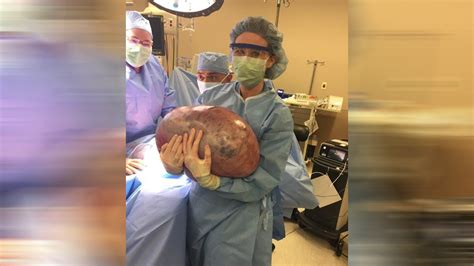 woman has 50 pound ovarian cyst removed
