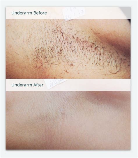 before and after photos of laser hair removal milan laser