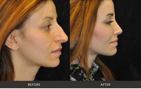 rhinoplasty nose surgery beverly hills los angeles west hollywood ca