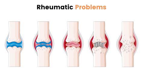 types  rheumatic problems sri ramakrishna hospital