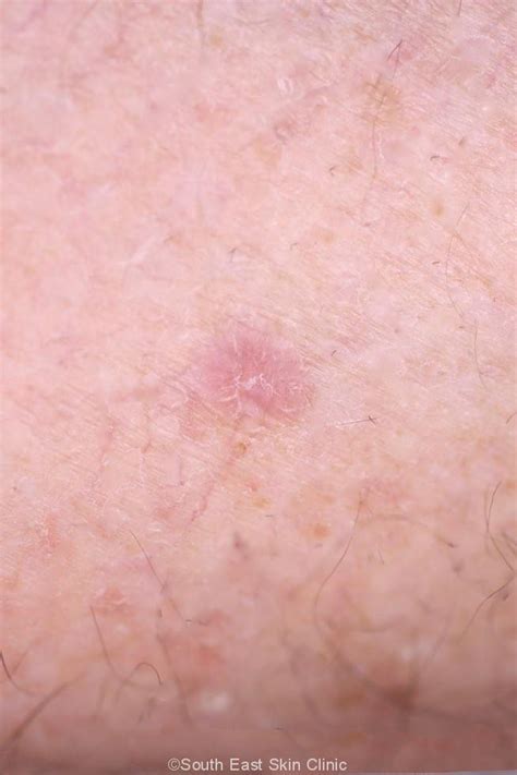 bcc basal cell carcinoma
