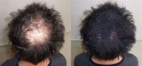 natural methods  cure baldness  hair regrowth