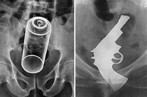 Buzz Lightyear And Mobile Phones Xrays Of Odd Objects Used In Sex