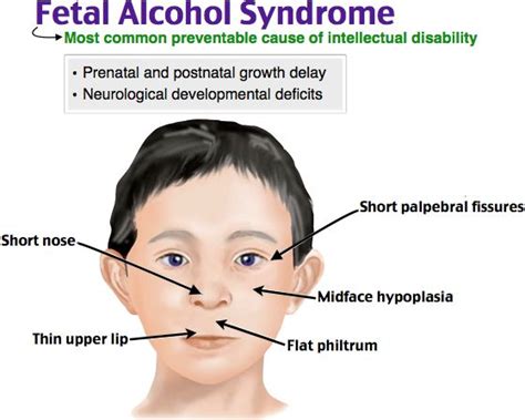 fetal alcohol syndrome fetal alcohol syndrome fetal