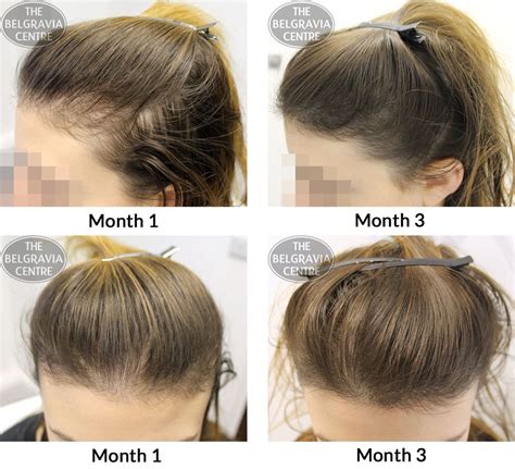 female pattern hair loss ferritin httpwwwhairlossmenwomencomfemale pattern hair loss fer