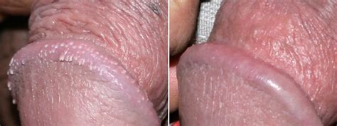 penis removal before and after