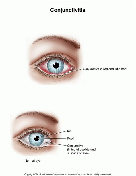 Eye Irritation Giant Papillary Conjunctivitis Tufts Medical Center