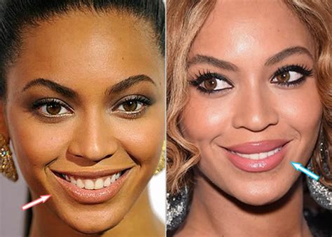 Beyonce’s Plastic Surgery Secrets Celebrity Plastic Surgery