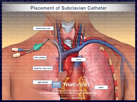 placement of subclavian catheter trialexhibits inc
