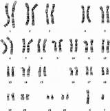 Chromosomal Abnormalities Chromosomes Karyotype Human Normal Male Xy Fig sketch template