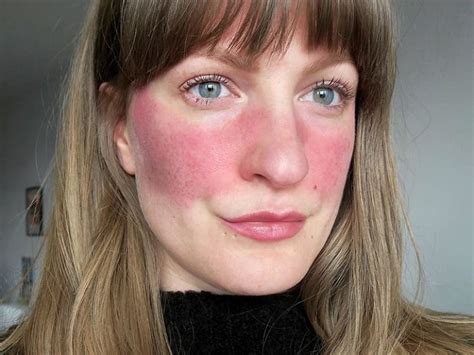 rosy cheeks     managed skin care top news