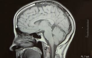 hersenscan spoort alzheimer  vroege fase op zna