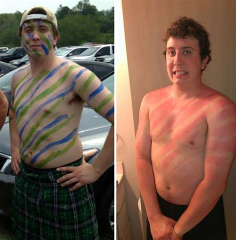 33 People Who Got Seriously Sunburned Ouch Gallery Ebaums World