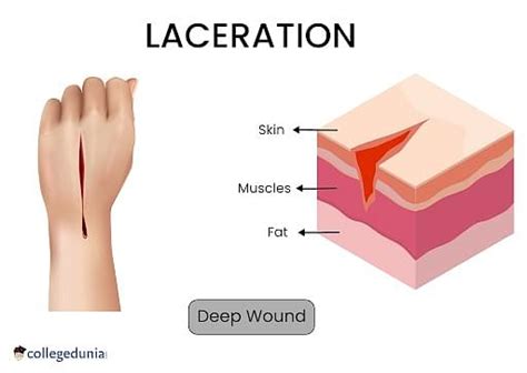 laceration  types  side effects