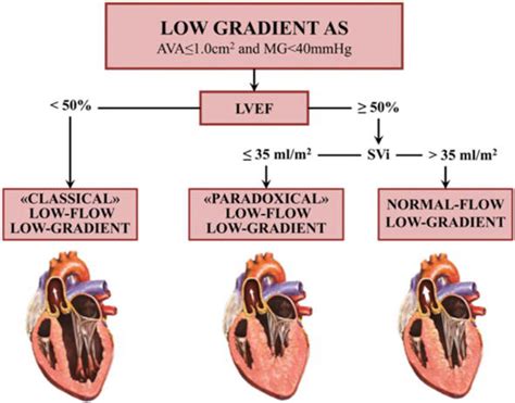 Low Flow Low Gradient Severe Aortic Stenosis Diagnosis
