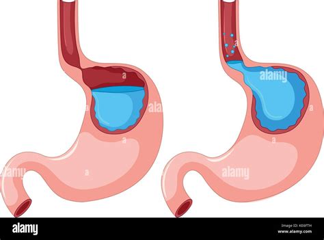 diagram  gastroesophageal reflux disease illustration stock vector image art alamy