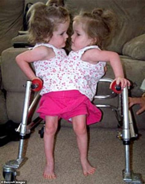 utah twins who have one leg each say they feel the same as everybody