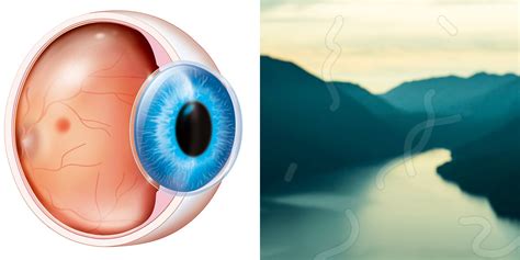 eye floaters   symptoms