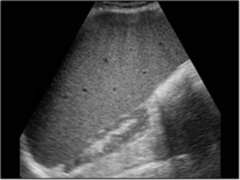 abnormal spleen ultrasound