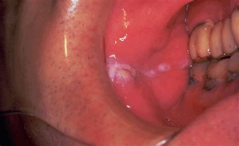 Oral Cancer