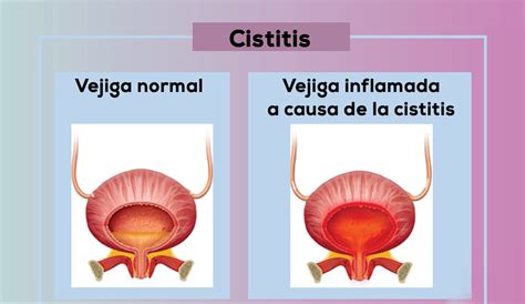 consultorio abierto cual es la diferencia entre cistitis  infeccion