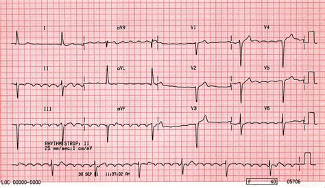 Case B10 Complete Heart Block And Atrial Flutter St Emlyns Ecg