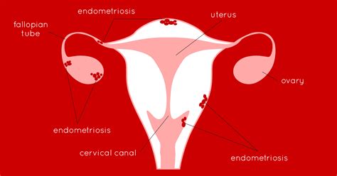 endometriosis ruby cup