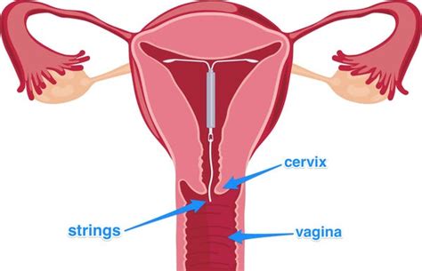 How To Check Iud Strings