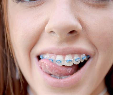 pin by jacob acuña on chicas con frenos teeth braces smiley piercing